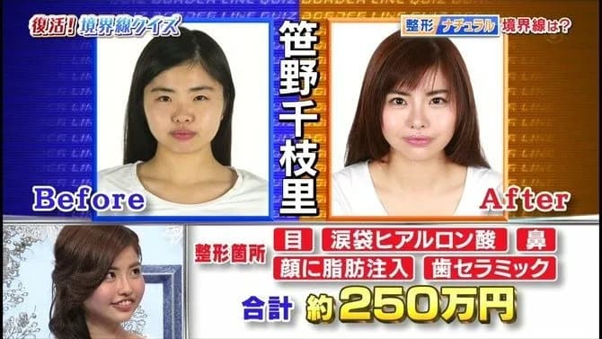 250万かけて整形して、石原さとみの顔になろうとした女性の末路が・・・