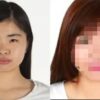 250万かけて整形して、石原さとみの顔になろうとした女性の末路が・・・